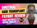 100% Genuine Patient Review | After Transplant surgery | F2 Hair Transplant & Skin Care, Chennai.