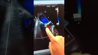 Mitraclip Video with Details