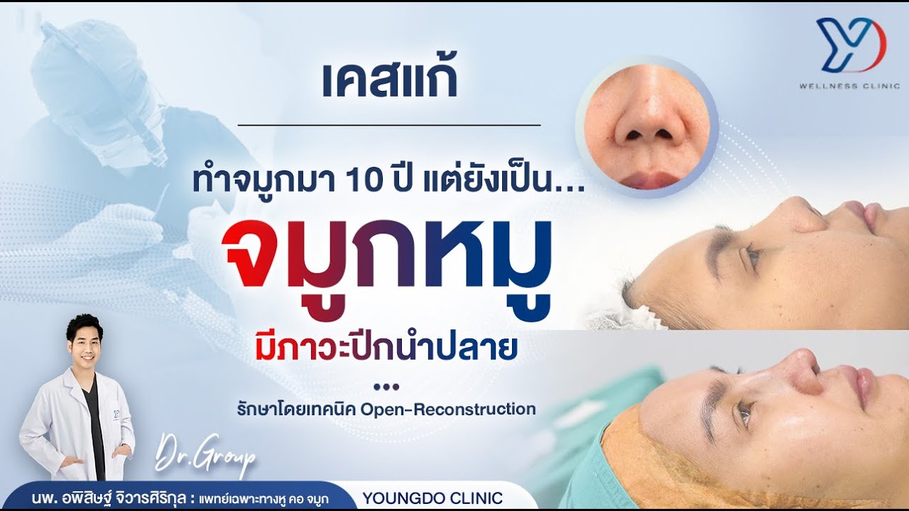 จมูกสั้น เหมือนหมู 🐷 เสริมมาแล้ว 10 ปี ‼️ | By หมอกรุ๊ป