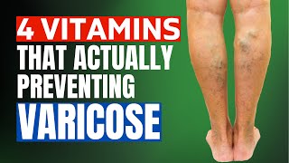 4 Vitamin Preventing Varicose Veins Forever | Varicose Veins Treatment | Varicose Veins Removal