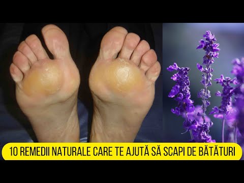 10 REMEDII NATURALE CARE TE AJUTĂ SĂ SCAPI DE BĂTĂTURI