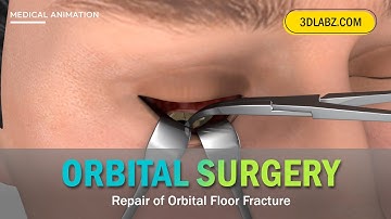 Orbital Floor Fracture Repair Surgery | Medical 3D Animation