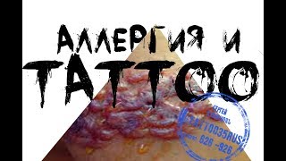Аллергия и тату. Можно ли делать тату. Как узнать последствия Аллергия и тату. Можно ли делать тату. Как узнать последствия