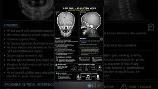 Subtle Skull Fracture or Normal Suture | Interesting Radiology Case