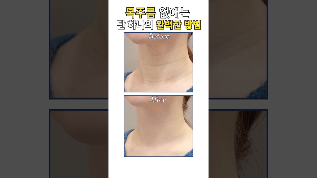 [Риэнжанг гоо сайхны мэс заслын эмнэлэг] Хүзүүний үрчлээний филлер #shorts