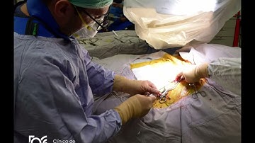 Sinus Node Dysfunction (Abnormality in the natural electrical impulses of the heart)