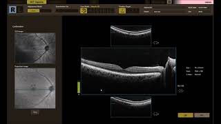 Canon Xephilio OCT A1 e HS100 - Eseguire un esame nozioni di base