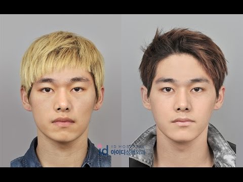 Guys Transform Into a Handsome Man, Plastic Surgery Korea Before and ...