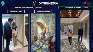 Caught Between Two Symptoms How DBS Broke a Parkinson s and Dyskinesia Cycle