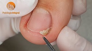 Nail trimming that helps comfort and gives the sensation of light feet [Podología Integral]