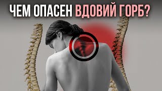 картинка: ЧЕМ ОПАСЕН ВДОВИЙ ГОРБ ИЛИ ХОЛКА? разбор от Георгия Темичева