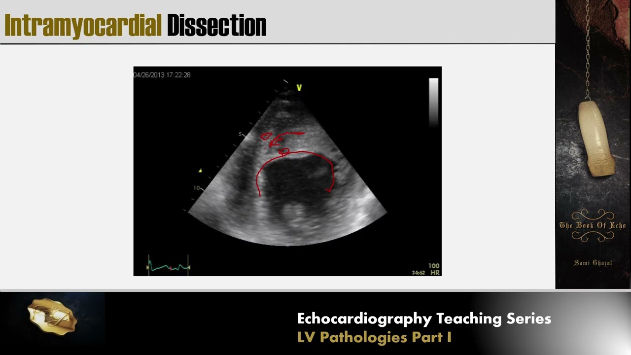 Lecture 16 - LV Pathologies Part I