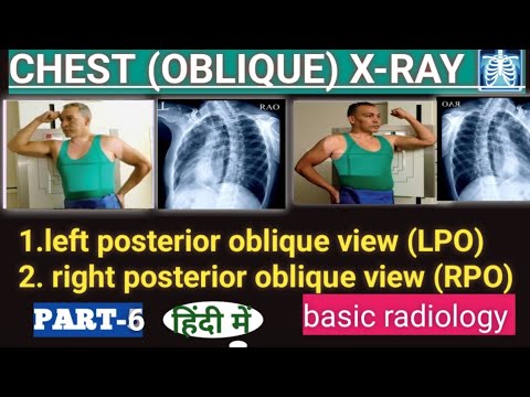 Chest X-Ray Oblique View # LPO/RPO Chest X-Ray #basicradiology - YouTube