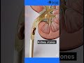 Kidney Stone Removal Animation How Kidney Stones Are Removed Rirs mp3
