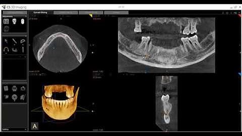 CS 3D Imaging   Mapping Mandibular Nerves