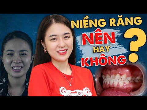 cách vệ sinh răng miệng khi niềng răng tại Kemtrinam.vn