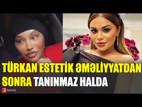 Türkan estetik əməliyyatdan sonra tanınmaz hala düşdü