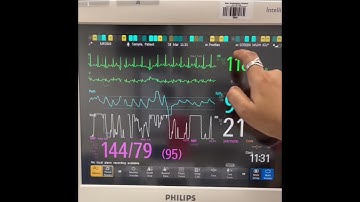 PICO Video: Alarm Fatigue