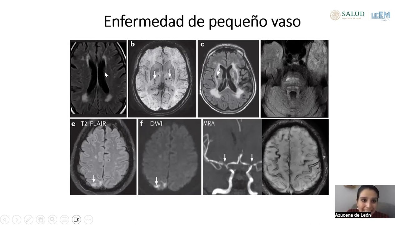 Herramientas de apoyo en esclerosis múltiple