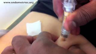 Injekció a prosztatagyulladás