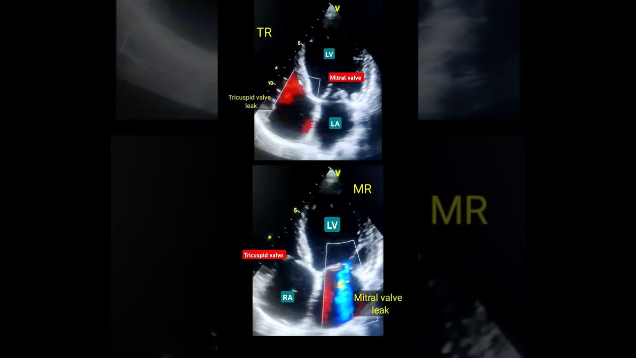 MR, TR ( valve Leak ) Echo l वाल्व इको 