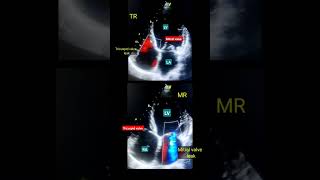 MR, TR ( valve Leak ) Echo l वाल्व इको #echo #shorts