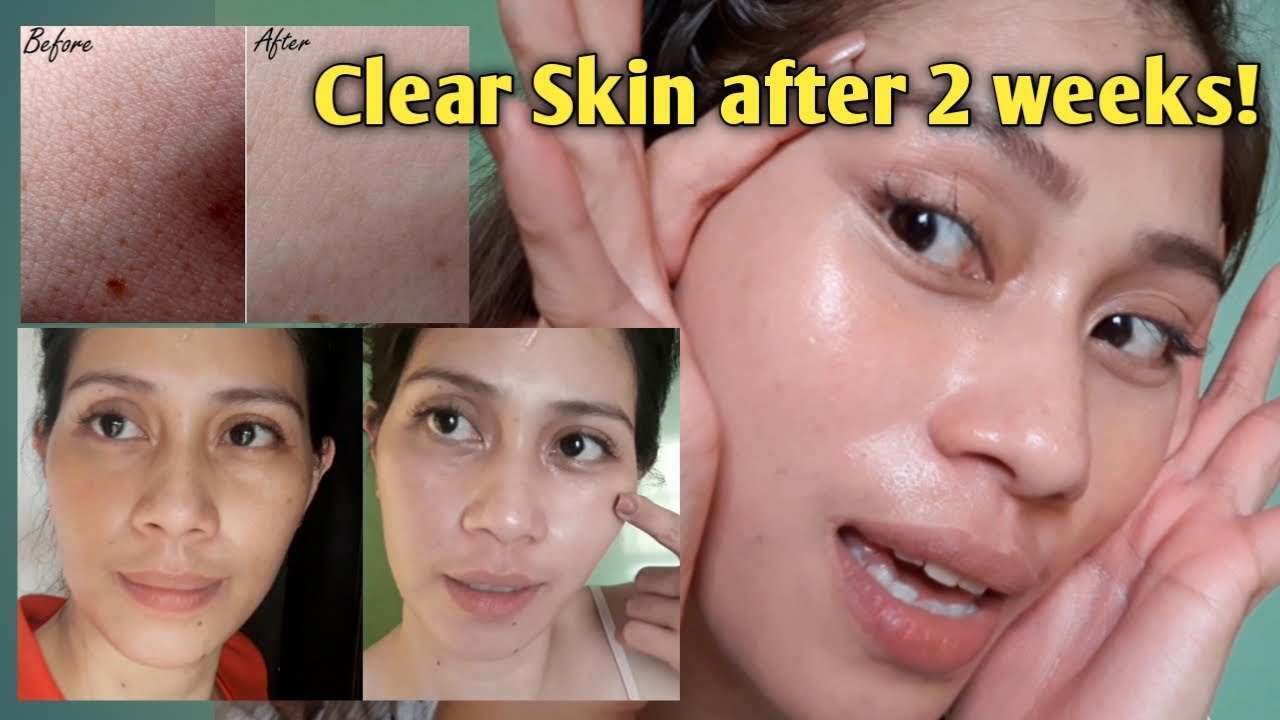 beautederm for pimple marks