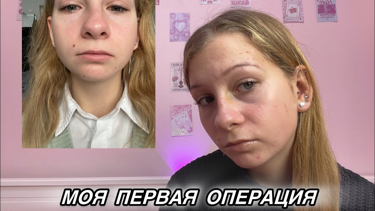РЕПОЗИЦИЯ КОСТЕЙ НОСА - «ОПЕРАЦИЯ ДЛИЛАСЬ 2 МИНУТЫ»