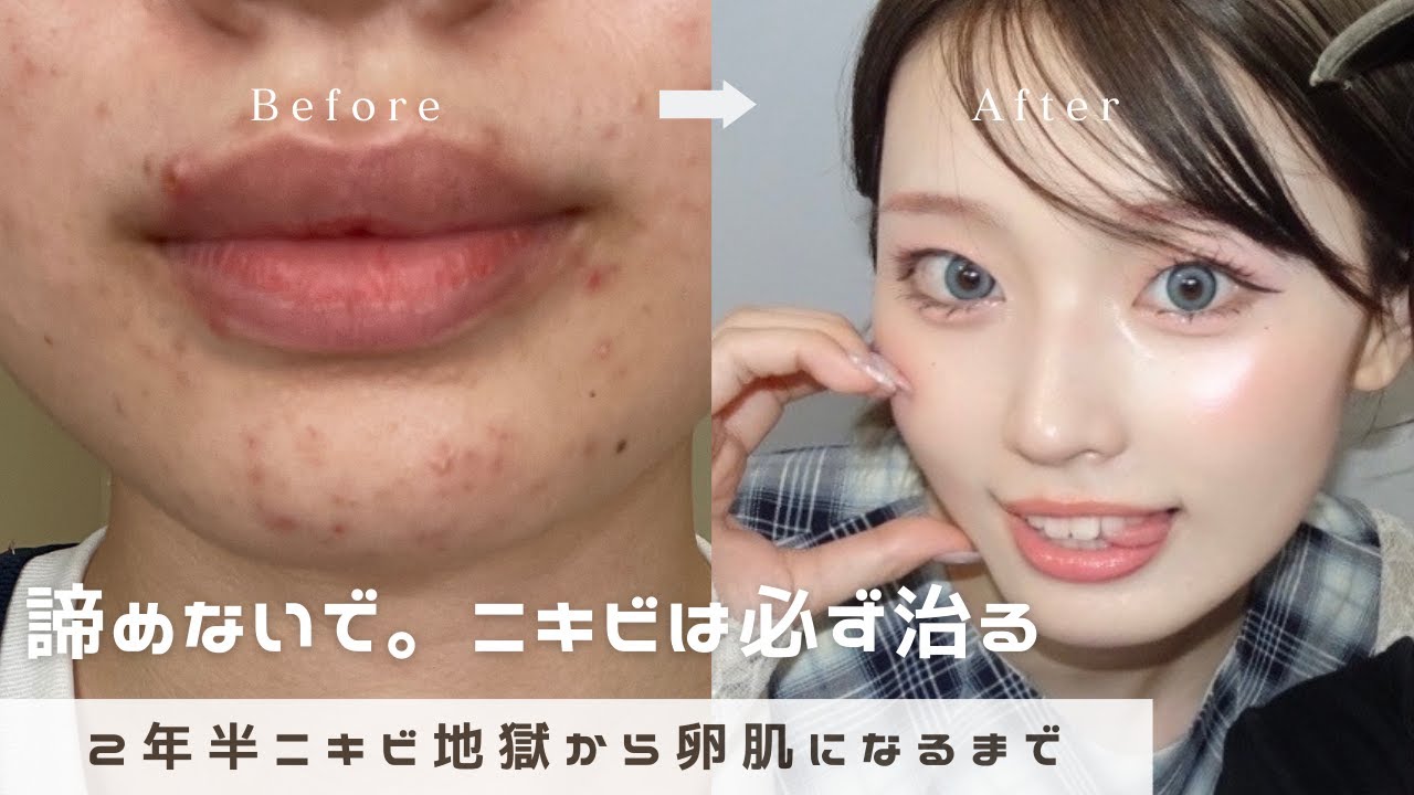 ニキビで悩んでる人絶対見て。2年半ニキビ地獄に悩んだ女がニキビゼロ卵肌になれた方法🥚✨