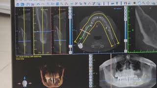 Download Lagu Tạo implant bằng Bluesky MP3