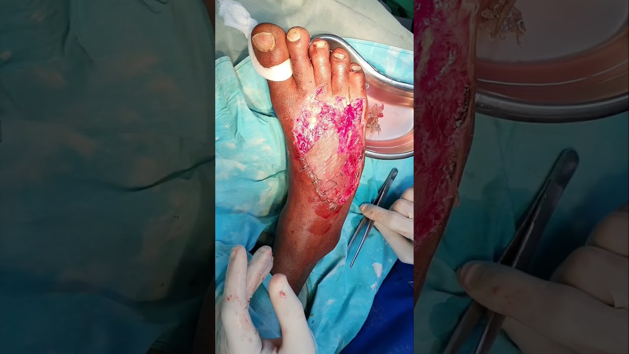 Infected degloving dorsum foot | Debridement and Split thickness skin grafting under SA | Adamya Hsp