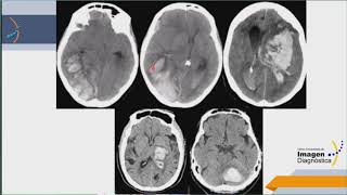 Imagenología del Sistema Nervioso: Patologías