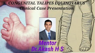 CONGENITAL TALIPES EQUINOVARUS Clinical Case Presentation