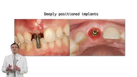 Tomas Linkevicius -12 Prosthetic hands-ons Bite registration material to increase transfer stability
