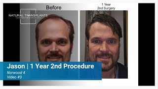 Norwood 4 Hair Transplant | 1 Year Second Coat of Paint Results | Dr. Huebner (Jason)