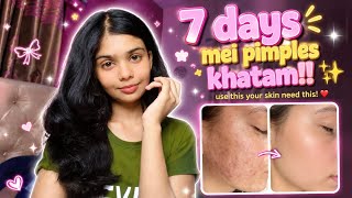 Glow up in 7 Days ✨ | 7 days mei Pimples Khatam !!❤️ Use this! | #youtube #explorepage #viral