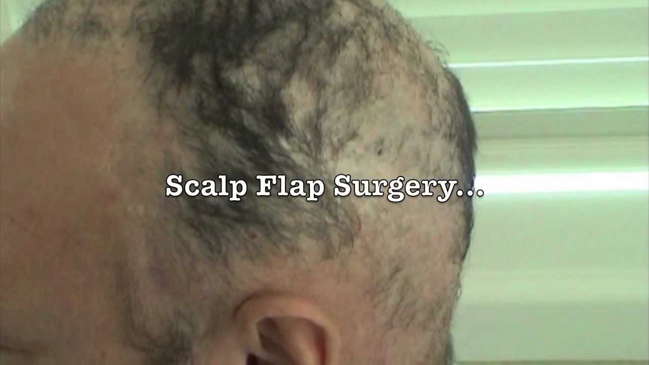 Hair Implants | Don't Work & Ruin Your Scalp | Get a FUE Hair Transplant