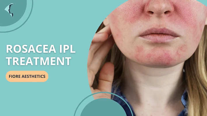 How I keep my Rosacea under control ? | IPL Rosacea Treatment