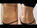 Check Out Dr. Ravi discuss Hi-Definition Abdominal Liposuction and Body Sculpting in Houston, Texas