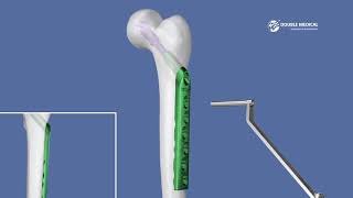 Double Medical Dynamic Hip Screw System