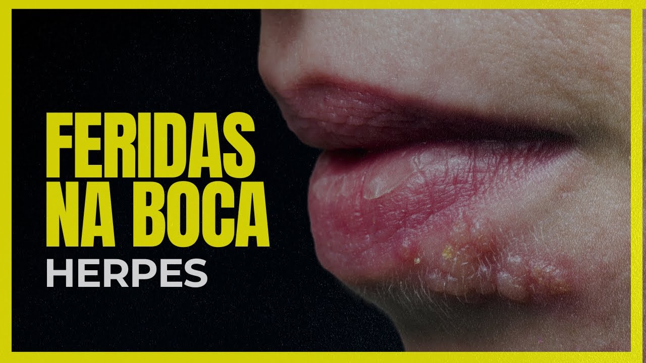 FERIDAS NA BOCA: DESCUBRA COMO EVITAR HERPES LABIAL - [TRANSMISSÃO ...
