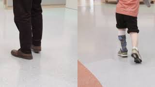 Before & After: Excess Plantarflexion | Toe Walking | DAFO 2