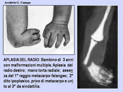 Video: Batti L'osteoporosi - Scheletri Nutritivi Ed Esercitabili (BONES): Uno Studio Randomizzato Controllato Di Gruppo Su Bambini