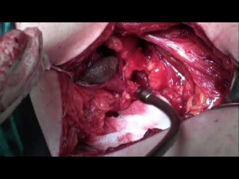 Böbrek Taşı Açık Ameliyatı (Posterior Vertical Lombotomy) - Prof. Dr. Yavuz Önol