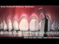 Pinhole Surgical Technique for Gum Recession in Fort Lauderdale, FL