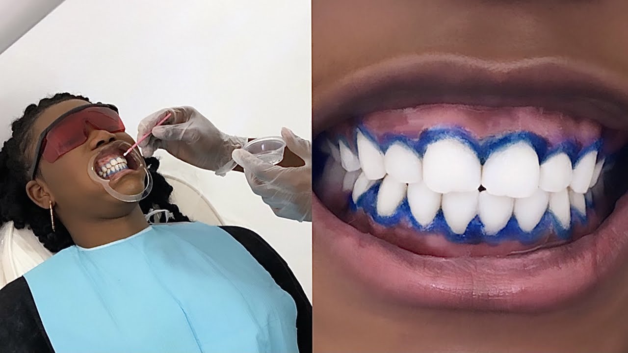 I got my teeth whitened in Ghana 🇬🇭