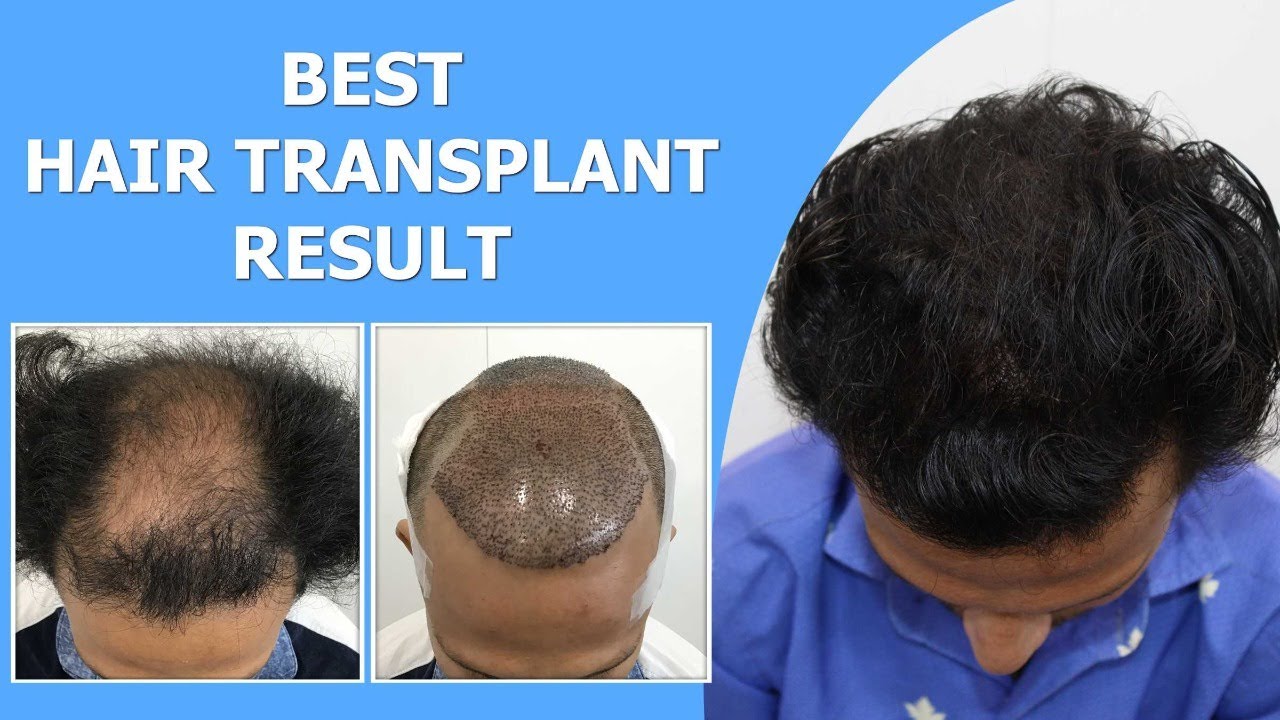 Best Hair Transplant In Surat 2021  Fue  No Root Touch Surgery  Before  And After 2200 Grafts  YouTube