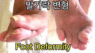 (ENG) 엄지발가락이 휜 발변형 치료 foot deformity treatment