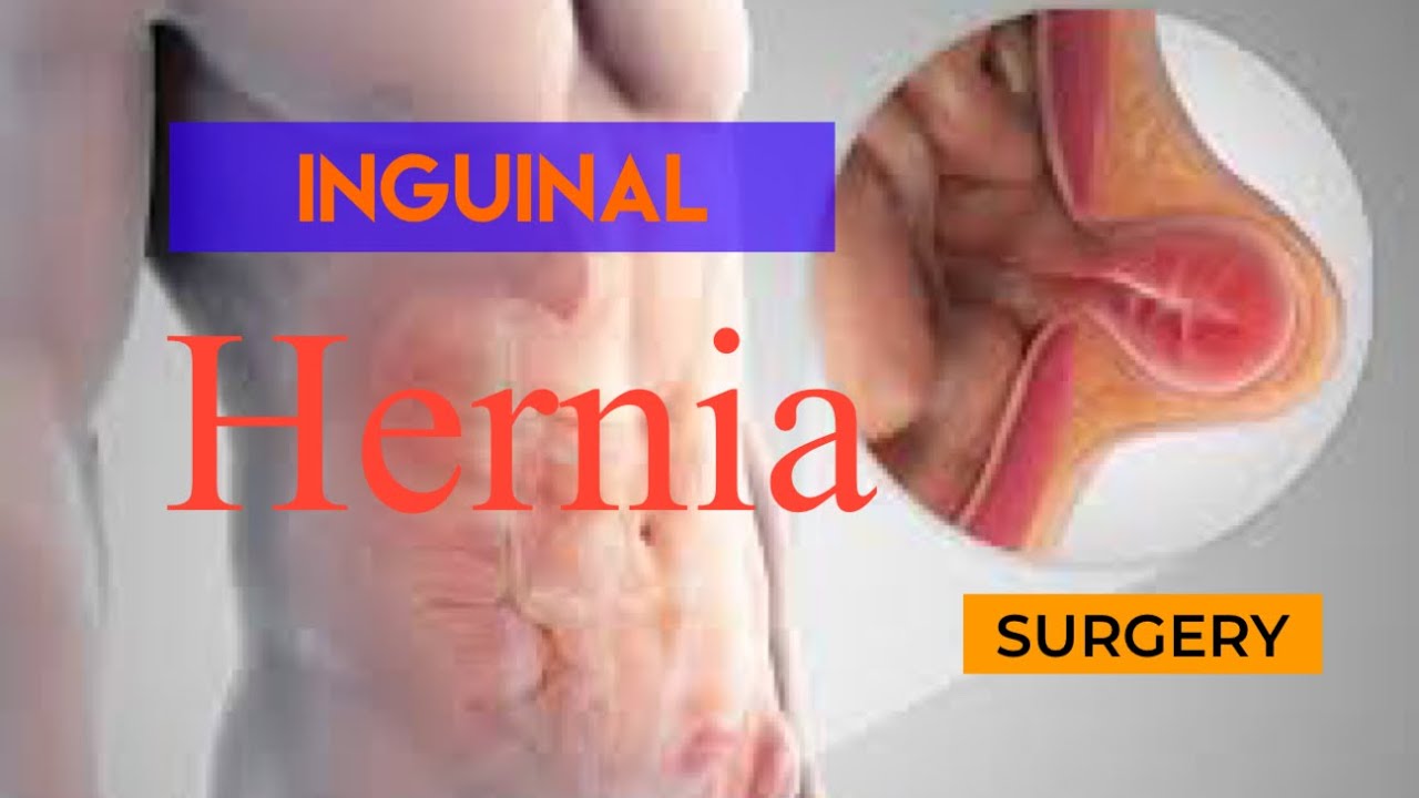 Es bueno andar después de operación hernia inguinal