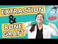 The Importance of Bone Grafts for Successful Dental Procedures